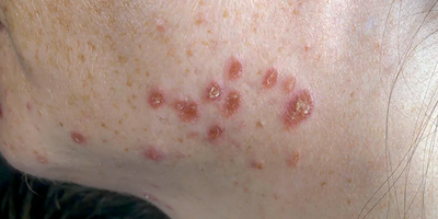 Bệnh u hạt (sarcoidosis)