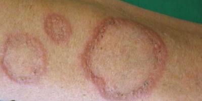 U hạt vòng (granuloma annulare)