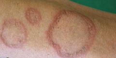 U hạt vòng (granuloma annulare)