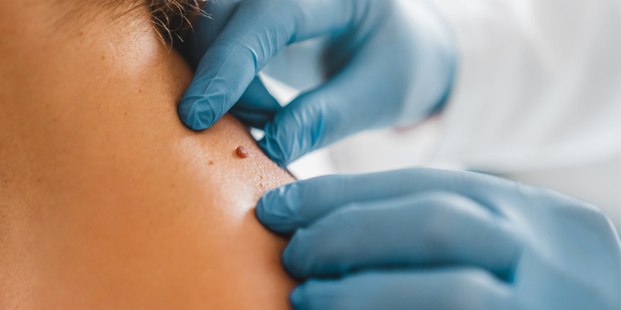 U mềm treo: Nguyên nhân, dấu hiệu và cách điều trị