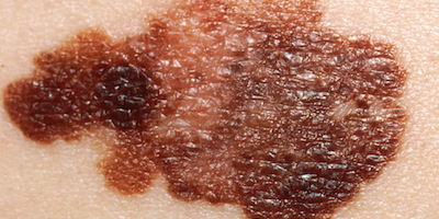 Ung thư tế bào hắc tố (melanoma)
