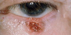 Ung thư biểu mô tế bào đáy (basal cell carcinoma)