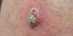Ung thư tế bào vảy (squamous cell carcinoma)