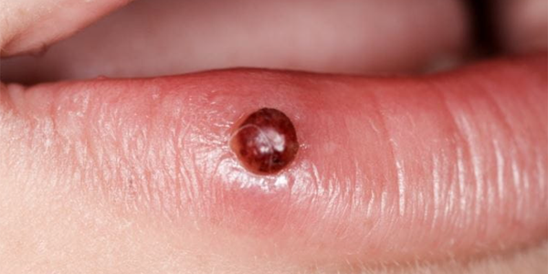 U hạt nhiễm khuẩn: Nguyên nhân, biểu hiện và phương pháp điều trị