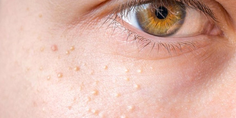 U ống tuyến mồ hôi là bệnh gì? Triệu chứng và nguyên nhân