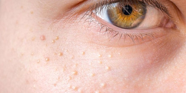 U ống tuyến mồ hôi là bệnh gì? Triệu chứng và nguyên nhân