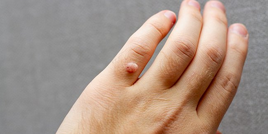 Mụn cóc là gì? Phương pháp điều trị và giảm lây lan?