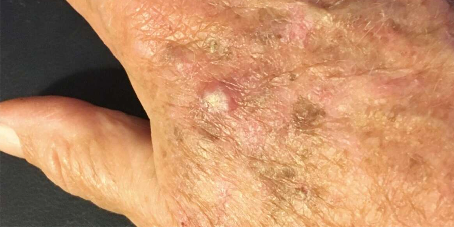 Bệnh dày sừng ánh sáng: Nguyên nhân, triệu chứng và phương pháp điều trị