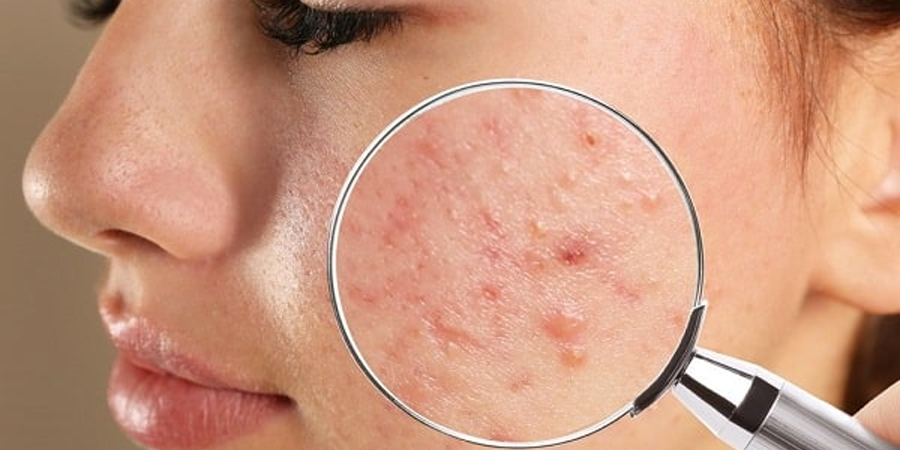 Điều trị mụn trứng cá triệt để với chuyên gia da liễu