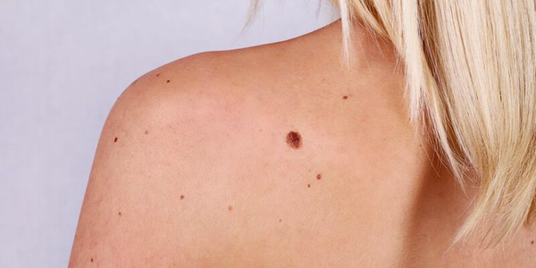 Dày sừng da dầu: Nguyên nhân, triệu chứng và cách điều trị