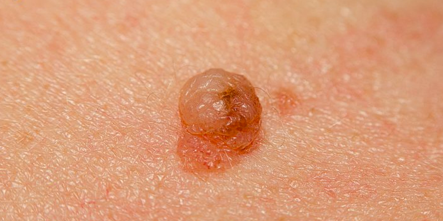 U nhú sinh dục là gì? Nguyên nhân và triệu chứng