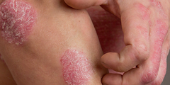 Bệnh vảy nến (psoriasis)