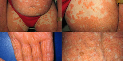 Vảy phấn đỏ nang lông (Pityriasis Rubra Pilaris)