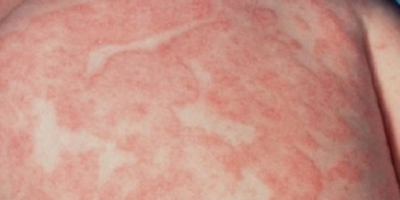 Vẩy phấn hồng (pityriasis rosea)