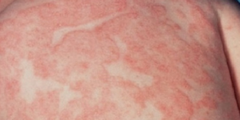 Vẩy phấn hồng (pityriasis rosea)