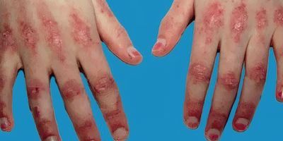 Viêm da cơ (viêm bì cơ) và viêm đa cơ