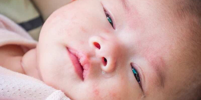 Trẻ bị viêm da cơ địa: nguyên nhân và cách điều trị tại nhà