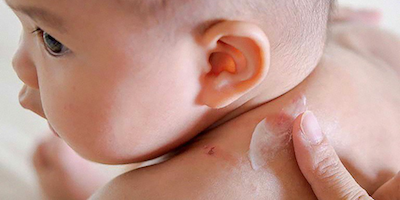 Điều trị bệnh viêm da cơ địa ở trẻ nhỏ