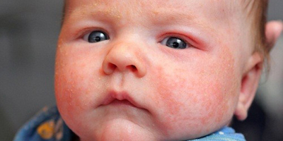 Trẻ bị viêm da cơ địa: Chăm sóc thế nào cho đúng?