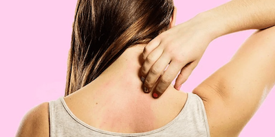 Nguyên nhân, triệu chứng viêm da cơ địa ở cả người lớn và trẻ nhỏ