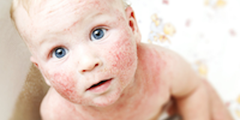Viêm da cơ địa (atopic dermatitis)