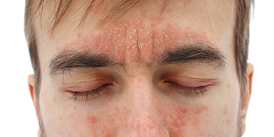 Viêm da dầu (seborrheic dermatitis)
