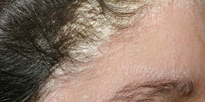 Viêm da dầu - căn bệnh gây khó chịu và mất thẩm mỹ