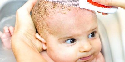 Viêm da đầu ở trẻ em và những điều cha mẹ cần biết