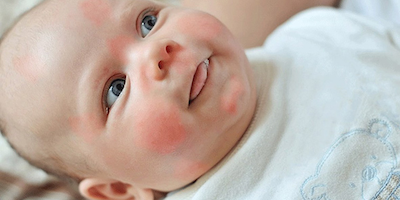 Các dạng viêm da dị ứng ở trẻ nhỏ