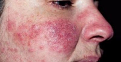 Viêm da do Demodex