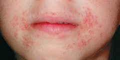 Viêm da quanh miệng (perioral dermatitis)