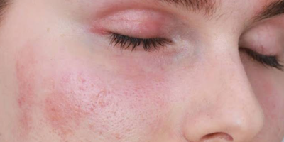 Viêm da tiếp xúc: Nguyên nhân triệu chứng và phương pháp điều trị