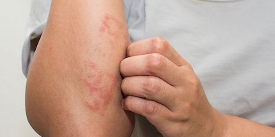 Viêm da tiếp xúc: Dễ mắc, khó chữa