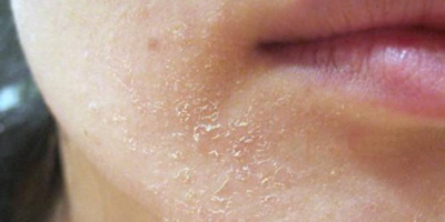 Các nguyên nhân và triệu chứng của viêm da tiết bã nhờn