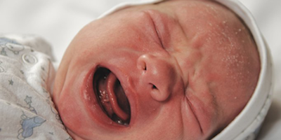 Viêm da tiết bã ở trẻ em