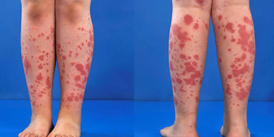 Viêm mạch (vasculitis)
