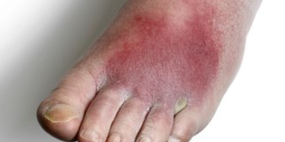 Viêm mô tế bào (cellulitis)