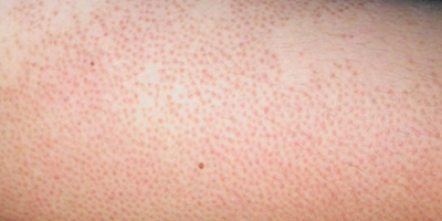 Viêm nang lông và nhọt