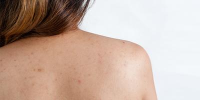 Viêm nang lông: nguyên nhân và cách điều trị hiệu quả