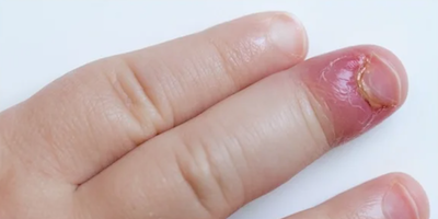 Viêm quanh móng (paronychia)