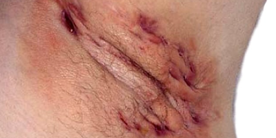 Viêm tuyến mồ hôi mưng mủ (hidradenitis suppurativa)