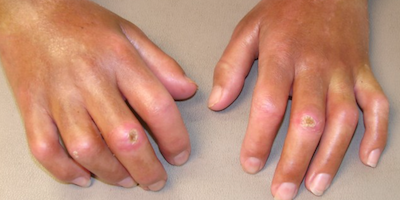 Xơ cứng bì hệ thống (systemic sclerosis)