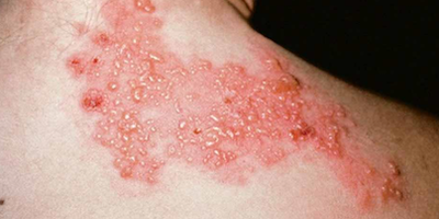 Bệnh zona (herpes zoster)