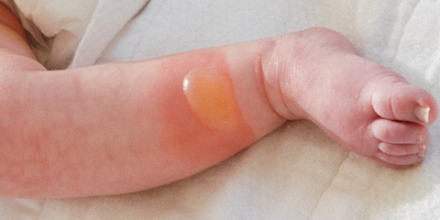 Bệnh da bọng nước