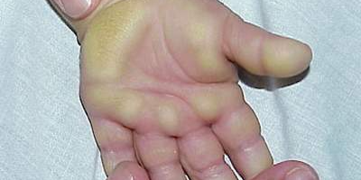 Bệnh da di truyền