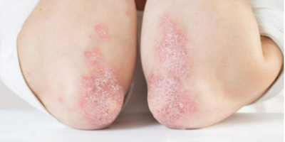 Bệnh do bất thường sừng hoá da