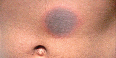 Phản ứng da do thuốc