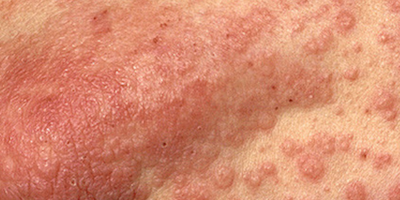 Ban đỏ và bệnh đỏ da
