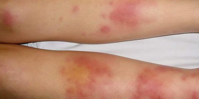 Bệnh của trung bì và tổ chức mỡ dưới da