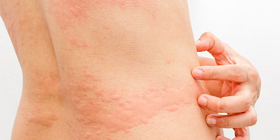 Mày đay và sẩn ngứa